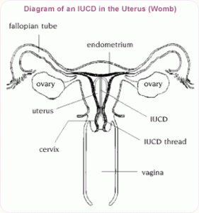 iucd Menggunakan IUCD untuk mencegah kehamilan